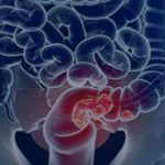 sus-adota-novo-exame-para-rastrear-cancer-colorretal-na-populacao
